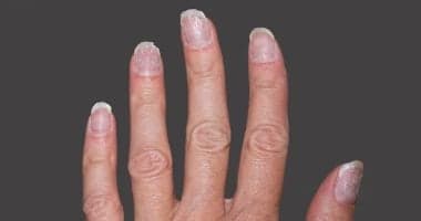 أظافرك مرآة صحتك: علامات تحذيرية يجب ملاحظتها
